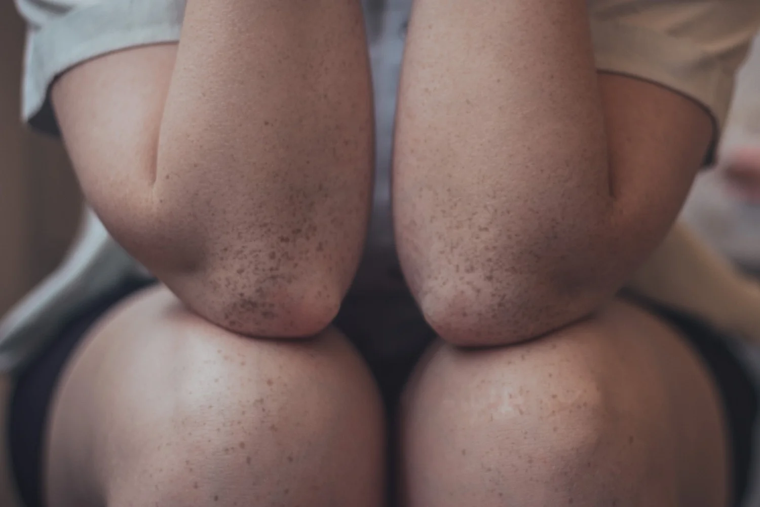 La culebrilla es un sarpullido doloroso causado por el virus del herpes zóster — ¿puede la monolaurina ayudar?